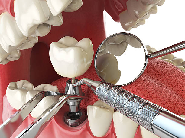 Best Emergency Root Canal Treatment in Olmsted Falls, OH